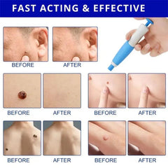 Skin Tag Remover, 2 In1 Painless Auto Skin Tag Remover, Mole Wart Removal Kit, Micro Skin Tag Remover
