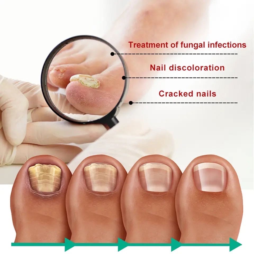 Nail Fungus Solution, Anti Infection Nail Fungus Removal Gel, Ingrown Toenail Treatment Nail Care Oil, Nail Fungus Treatments Serum