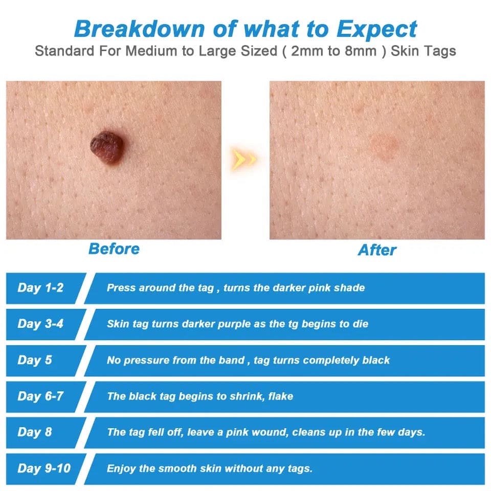 Skin Tag Remover, 2 In1 Painless Auto Skin Tag Remover, Mole Wart Removal Kit, Micro Skin Tag Remover