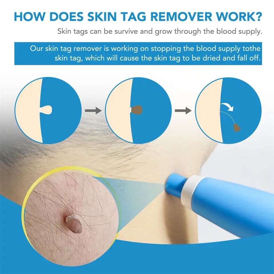 Skin Tag Remover, 2 In1 Painless Auto Skin Tag Remover, Mole Wart Removal Kit, Micro Skin Tag Remover
